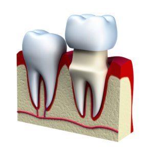 Image of how a dental crown, one of the more common restorative dentistry services at John B Chrispens DDS, fits over the rest of the tooth. 