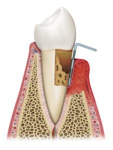 Illustration of how they check gum health to help fight gum disease as part of preventive dentistry at John B Chrispens DDS in Newport Beach, CA.